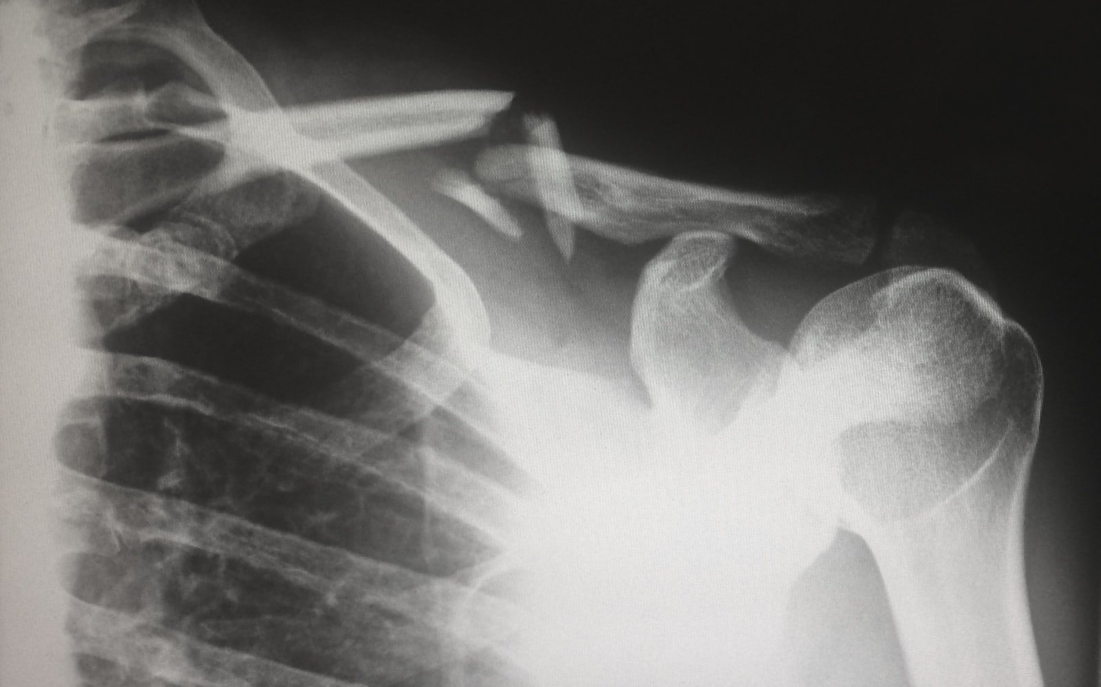 Orthopaedics & Joint Replacement