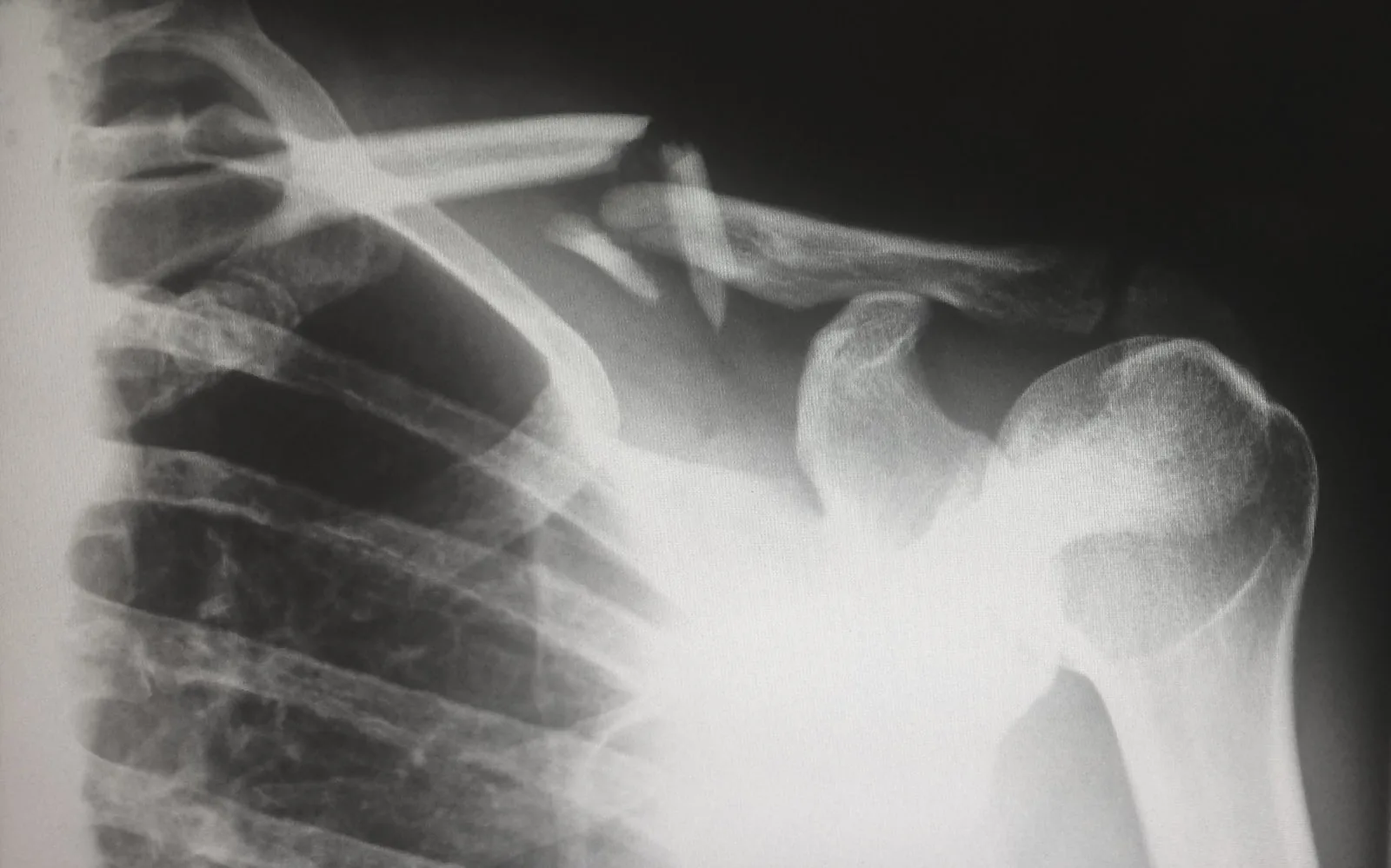 Orthopaedics & Joint Replacement